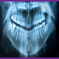 میزان اشعه رادیوگرافی دندان