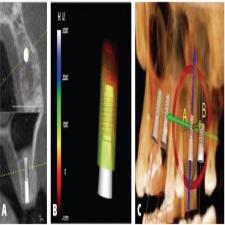 نقش CBCT در طرح درمان و قرار دادن ایمپلنت