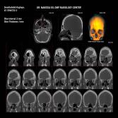 CBCT