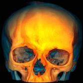 CBCT