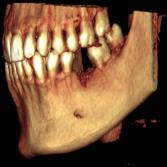 CBCT